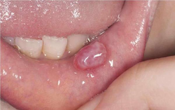 همه چیز راجع به کیست دهانی موکوسل
