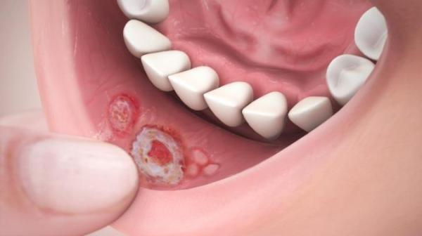 تبخال دهانی چیست و چگونه درمان میشود؟