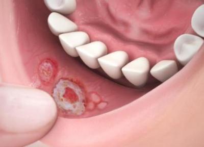 تبخال دهانی چیست و چگونه درمان میشود؟